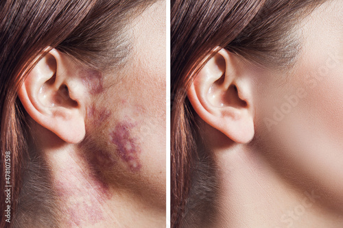 Slika na platnu Closeup of before and after treatment woman face with real port wine stain or birthmark on face