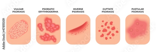 Psoriasis. Allergic eczema types, rashes treatment. Dermatology infectious spots, skin disease. Epidermis infection problems recent vector concept