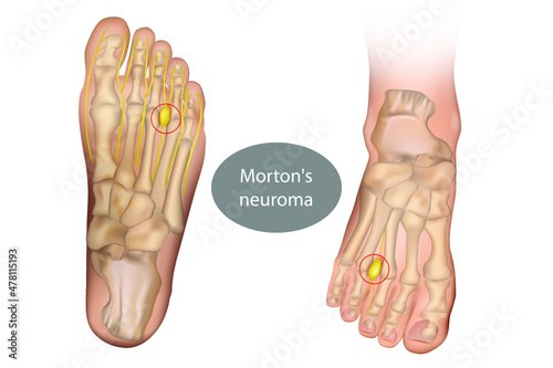 Morton neuroma, Morton's metatarsalgia, Intermetatarsal neuroma, and Intermetatarsal space neuroma. Neurology  photo