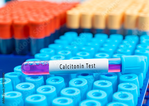 Biochemistry Blood sample for calcitonin test photo