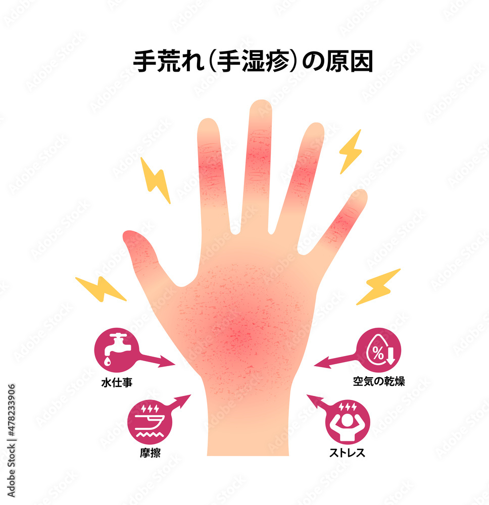 主婦湿疹 Images Browse Stock Photos Vectors And Video Adobe Stock