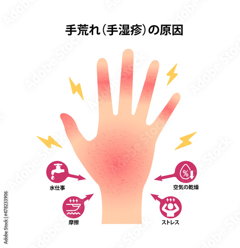 手荒れ (手湿疹) の原因 ベクターイラスト