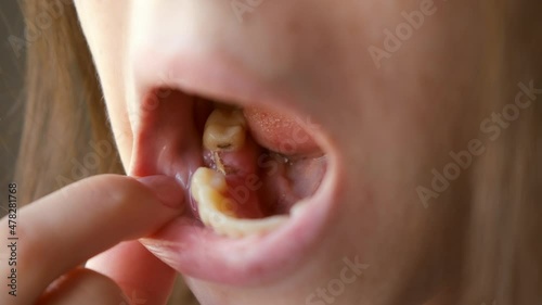 Wallpaper Mural Young woman is looking on her removed sixth tooth on which the suture is applied. Dental treatment, care. Orthodontic cure. Healing of dental wounds. Torontodigital.ca