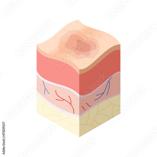 Skincare medical concept. Problems in cross-section of human skin horizontal layers structure. Anatomy illustrative model