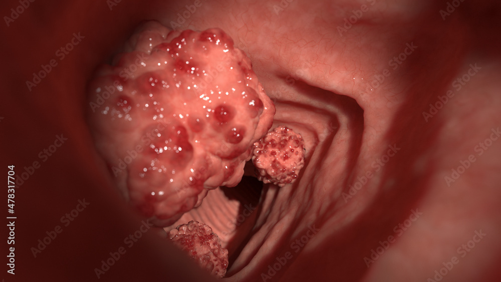 Fototapeta premium 3d rendered illustration of colon tumors