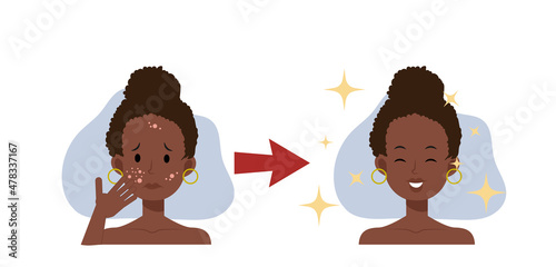 treat acne,skin problem,pimple .african american woman face.Beautyful. Flat vector 2d cartoon character illustration. Before, after