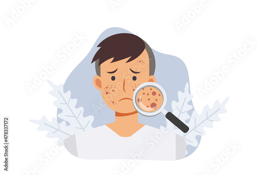 Acne skin problems Concept.man with magnifying glass is looking acne on his facial. Falt vector cartoon illustration.