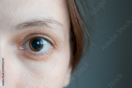 Close-up of a woman's brown eye with dilated big pupil. Eye drops after a visit to an ophthalmologist. Concept of healthy vision. Ophthalmological examination and treatment.