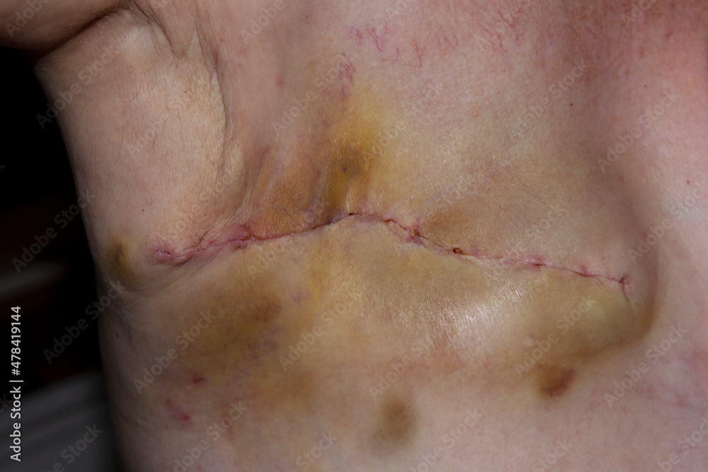 Fresh scarring after mastectomy surgery for breast cancer. Fresh scarring after mastectomy surgery for breast cancer.