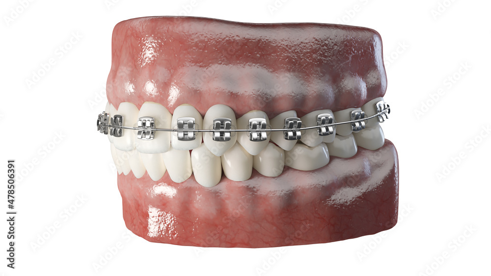 3d rendered illustration of dental braces 3d rendered illustration of dental braces
