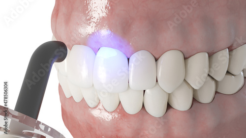 3d rendered illustration of a dental bonding process photo