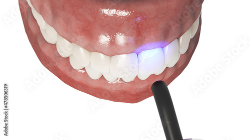 3d rendered illustration of a dental bonding process