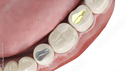 3d rendered illustration of different dental fillings photo