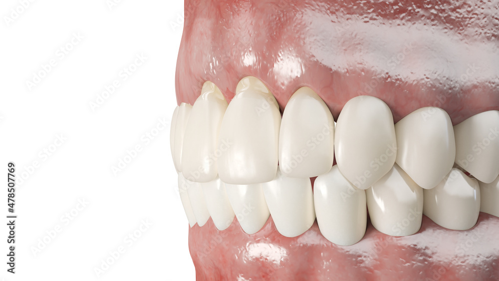 3d rendered illustration of a dental gum recession