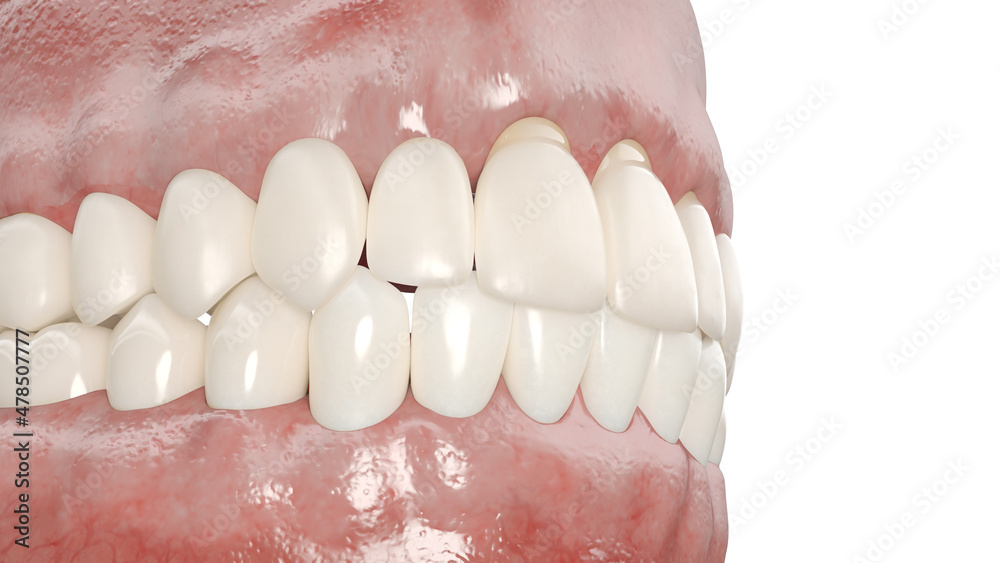 3d rendered illustration of a dental gum recession
