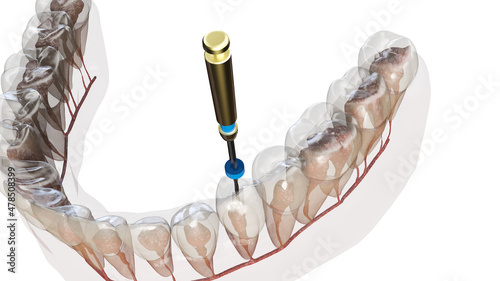 3d rendered illustration of a root canal treatment photo