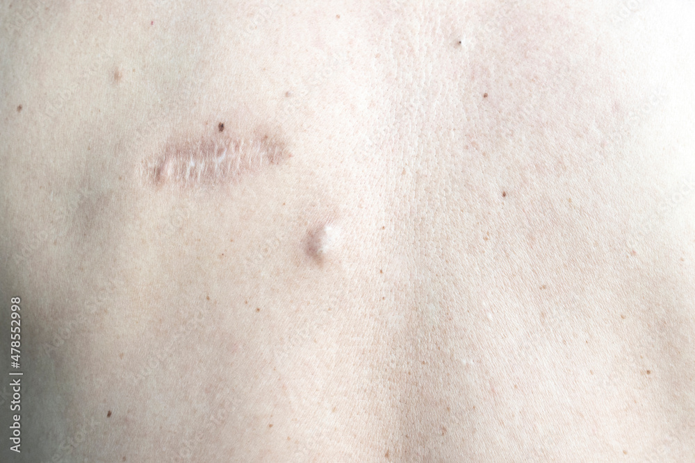 Fototapeta premium Image of a person's skin with scars