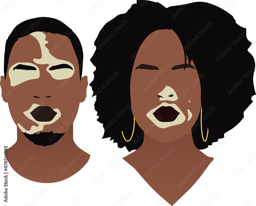 Vector drawing of a face. People with vitiligo. Skin pigmentation. Flat