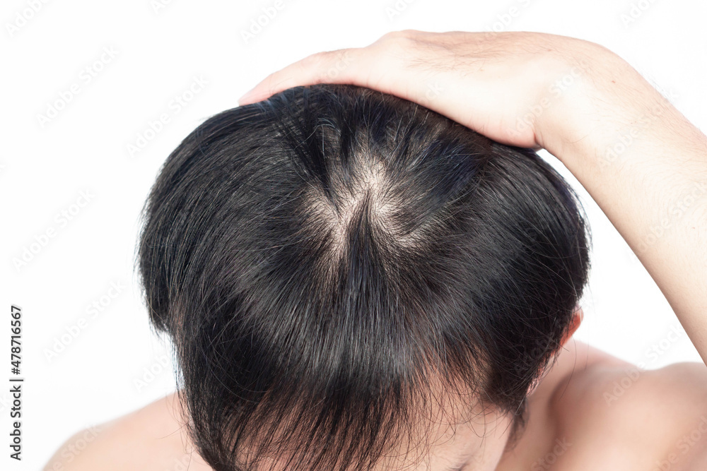 Closeup Young man serious hair loss and grey hair problem with white backgroun for health care medical and shampoo product concept, selective focus Closeup Young man serious hair loss and grey hair problem with white backgroun for health care medical and shampoo product concept, selective focus