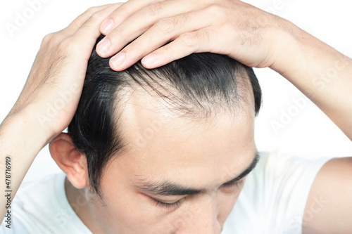 Closeup Young man serious hair loss problem with white backgroun for health care medical and shampoo product concept, selective focus