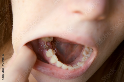 Young woman is looking on her removed sixth tooth on which the suture is applied. Dental treatment, care. Orthodontic cure. Healing of dental wounds.