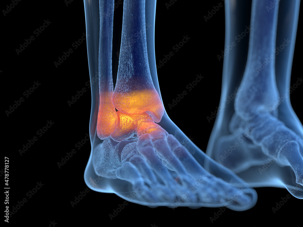 3d rendered illustration of an inflamed ankle 3d rendered illustration of an inflamed ankle