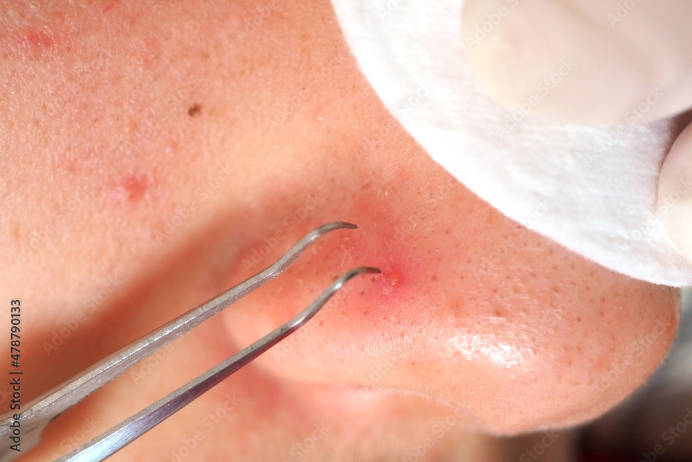 Fototapeta premium Removing blackheads on the nose
