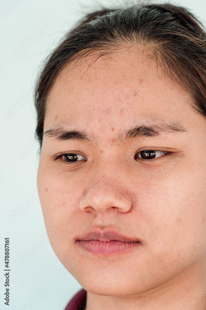 Obraz premium Close up of young Asian woman worry about her face when she has problems with skin on her face. Problems with acne and scar on the female skin. Problem skincare and health concept.