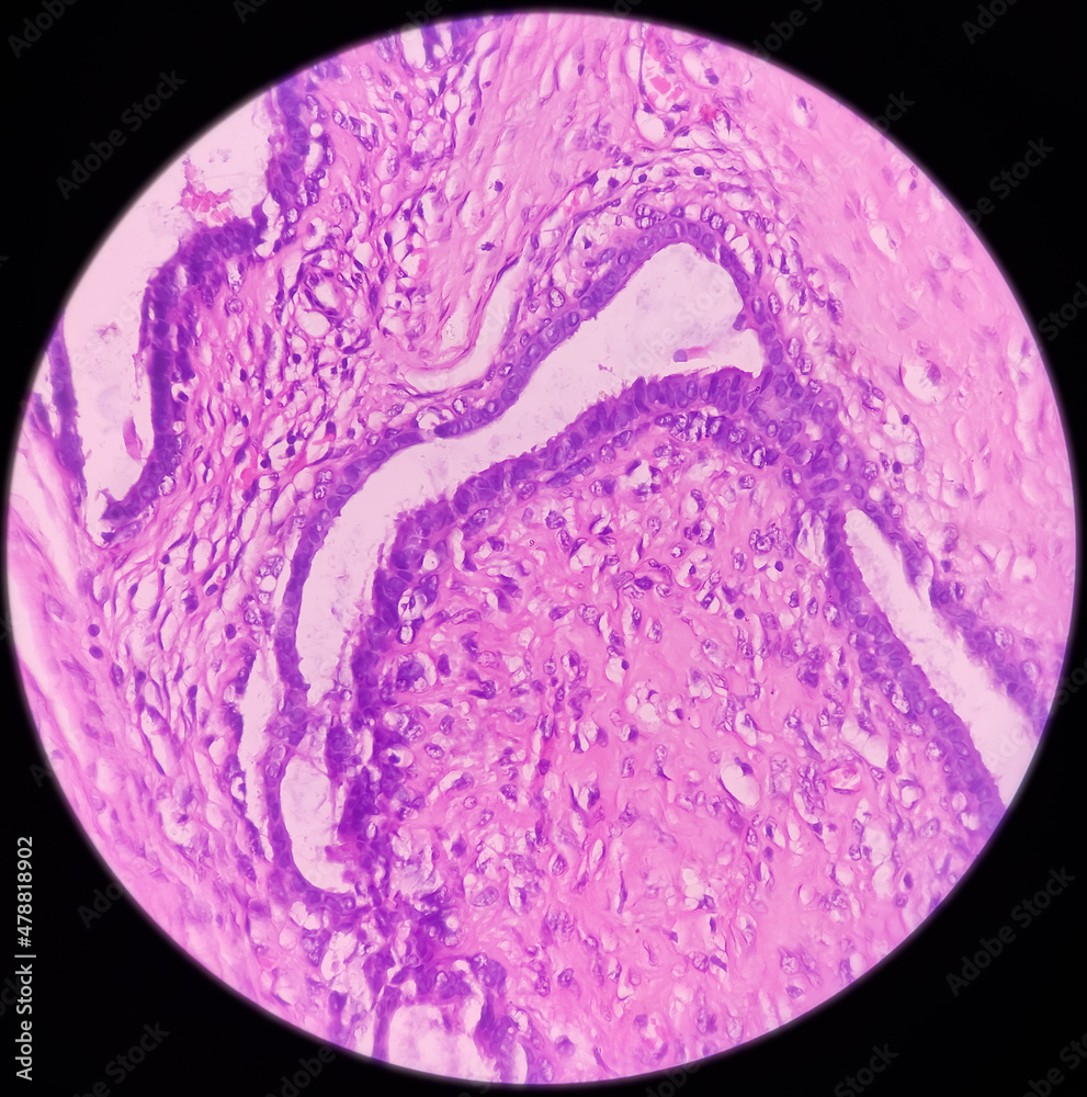 Breast Biopsy: Microscopic image of a fibroadenoma, show benign neoplasm composed of delicate proliferation of fibro muscular and glandular tissue on a myxoid background, benign tumor. Breast Biopsy: Microscopic image of a fibroadenoma, show benign neoplasm composed of delicate proliferation of fibro muscular and glandular tissue on a myxoid background, benign tumor.
