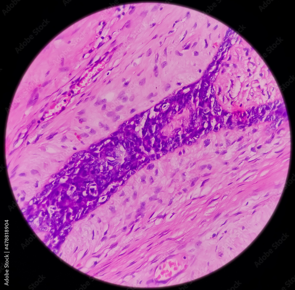 Breast Biopsy Microscopic image of a fibroadenoma, show benign neoplasm composed of delicate