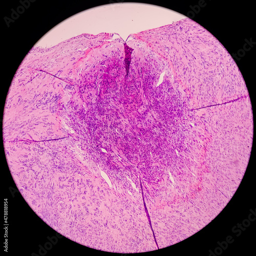 Fibroid uterus leiomyoma, myoma, also known as fibroids, benign tumor of the uterus, photo under microscope, no malignancy seen photo