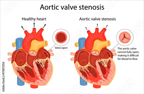 The medical illustration shows the difference between a normal aortic valve and a stenotic valve. cartoon style illustration photo