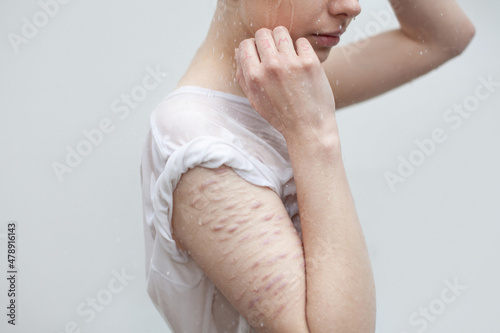 Young woman with pale scars arm