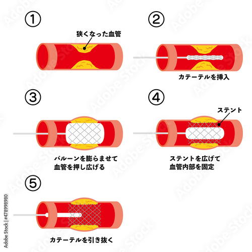 カテーテル治療の図解イラスト