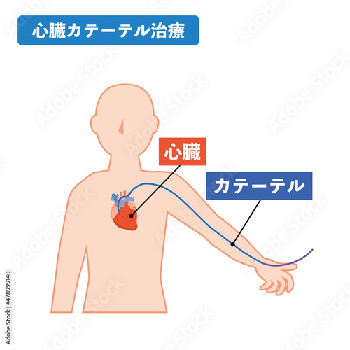 心臓カテーテル治療のイメージ