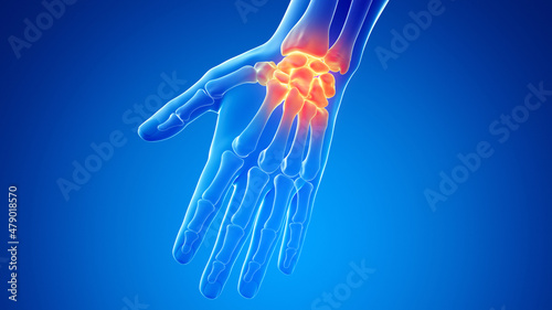 3d rendered illustration of a painful wrist photo