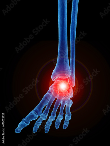 3d rendered illustration of a painful ankle