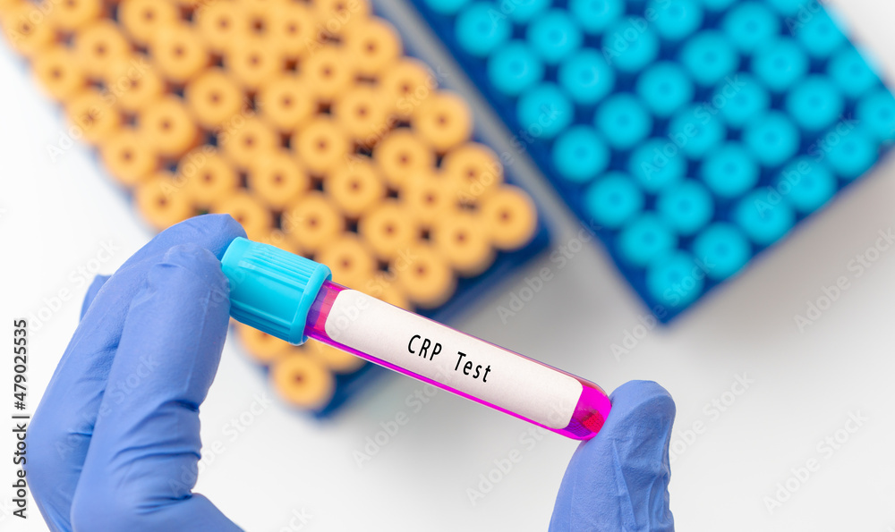 C-reactive protein (CRP) test result with blood sample in test tube on  doctor hand in medical lab Photos | Adobe Stock