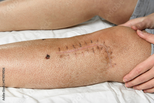 Postoperative suture on woman's leg. Closeup of scar after knee fracture. Traces of interrupted sutures leg after surgery. Recovery and wound healing concept. photo