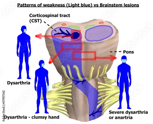 The different clinical presentation on the different brainstem lesions. photo