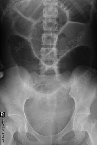 Foto x ray of a bowel dilatation ,small bowel obstruction,small intestine ileus