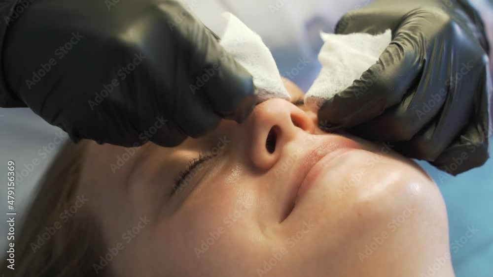 Doctor squeezes out pimples on face of woman. Hands in black gloves hold sterile sponges and remove dirt and pimples from fair skin. Lamp and magnifying glass illuminate face. Skin cleansing procedure
