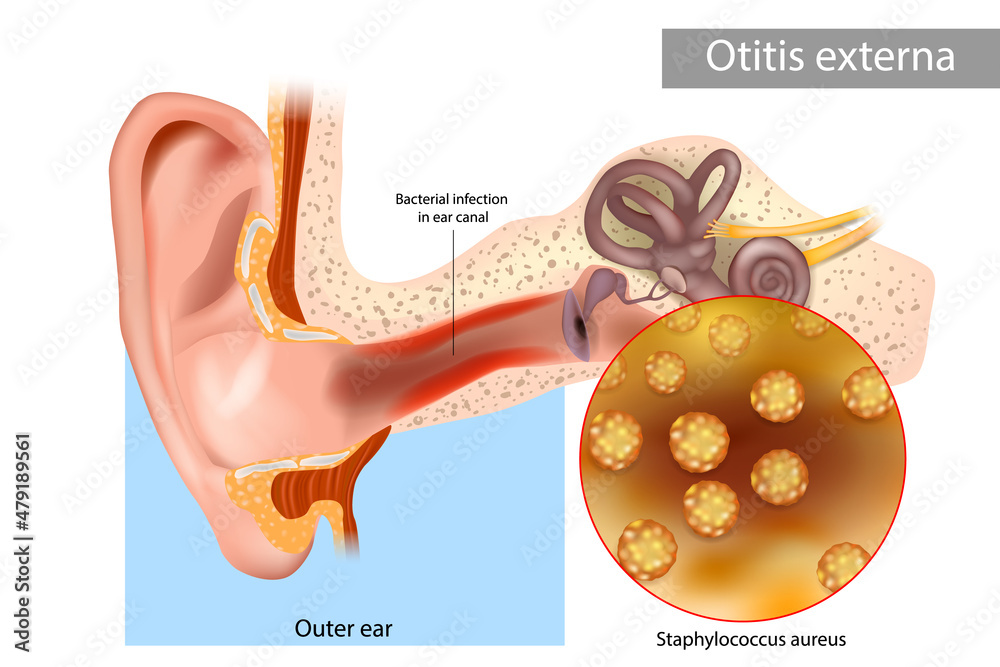 Otitis externa also called swimmer's ear. Inflammation ear canal of the