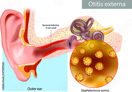 Otitis externa also called swimmer's ear. Inflammation ear canal of the Staphylococcus aureus. Infected outer ear. Human Ear Anatomy photo