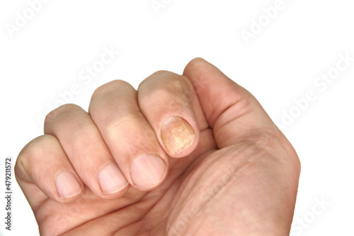 Nail fungus sample on a hand finger. An example of nail and skin health. Single palm image is on a clear white background. photo
