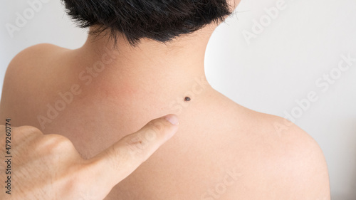 A mole on the back of a boy