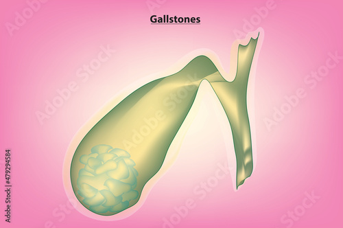 Biological illustration of healthy gallbladder and stone-like objects on gallbladder 