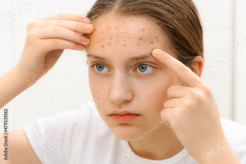 portrait of a teenage girl touches her face with pimples, acne on the skin