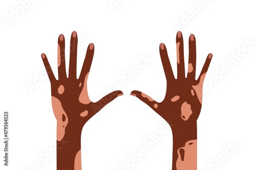 African American hands with vitiligo disorder skin. Two hands with white spots on skin. Autoimmune disease. World Vitiligo Day Colored flat cartoon vector illustration isolated on white background.