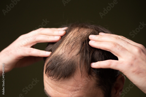 A man with baldness on a dark background head close-up.